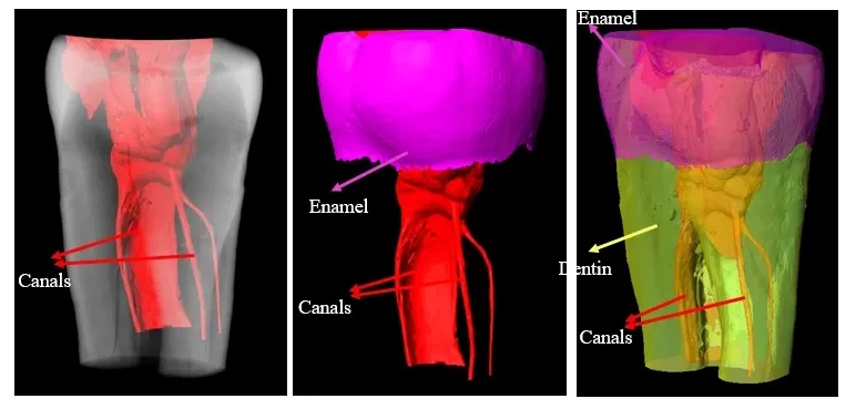 Example of a 3D image made with LOTUS-3D software of a human tooth