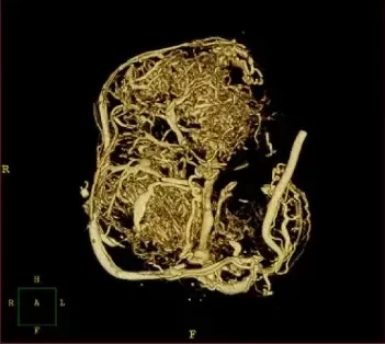 Pancreatic tumor vasculature in a mice