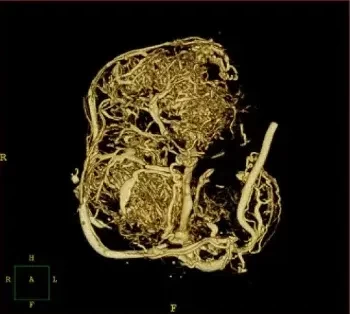 Pancreatic tumor vasculature in a mice