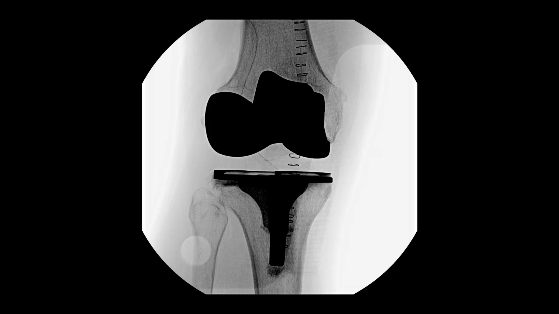 Orthopedic C-arm Image