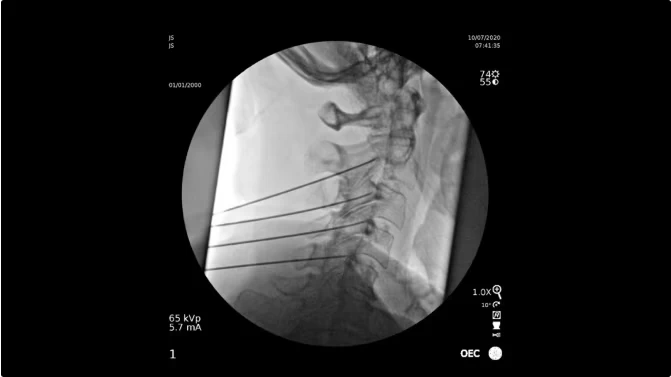 Pain Management C-arm Image