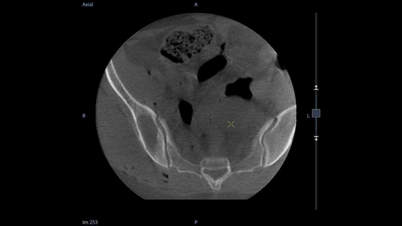 3D C-arm Axial