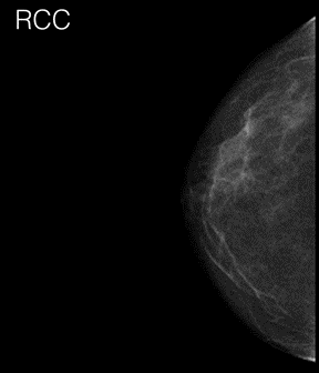 Right craniocaudal mammogram