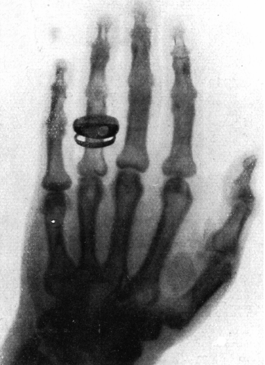 x-ray image of Rudolf Albert von Kölliker’s hand