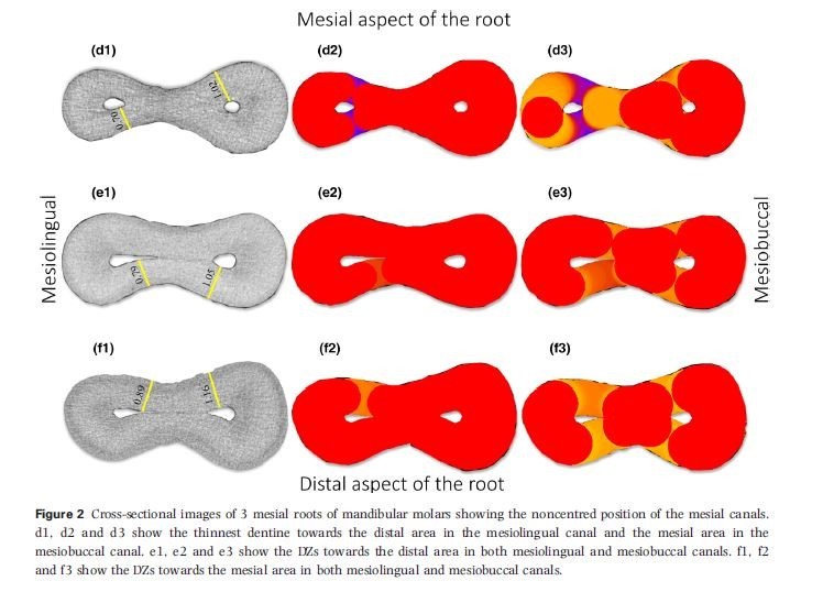 Anatomic danger zone reconsidered: a micro‐ CT study on dentine thickness in mandibular molars