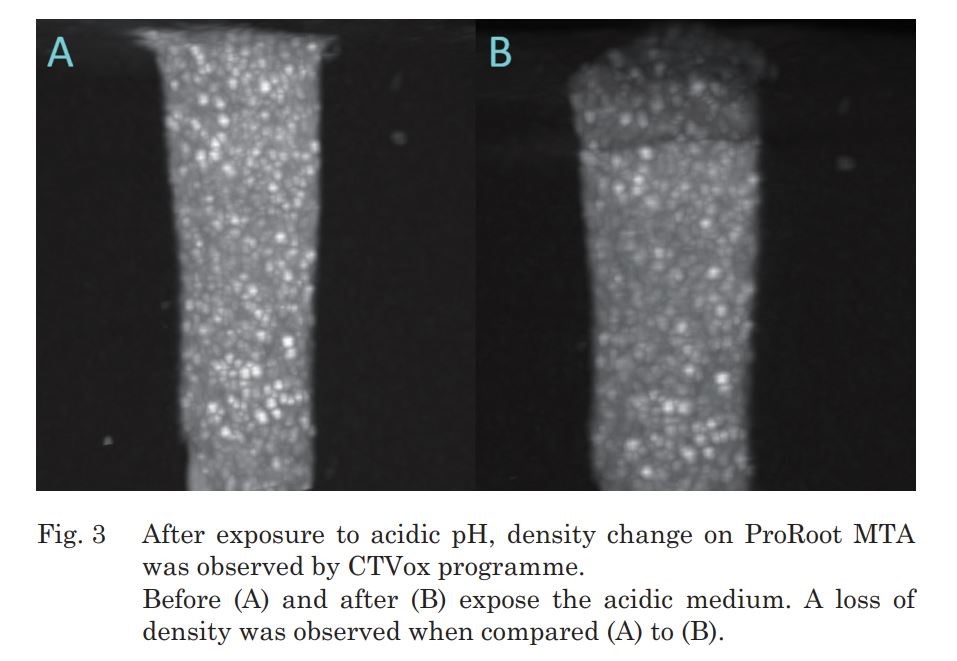 Physical Properties of MTA, BioAggregate and Biodentine in Simulated Conditions: A micro-CT Analysis