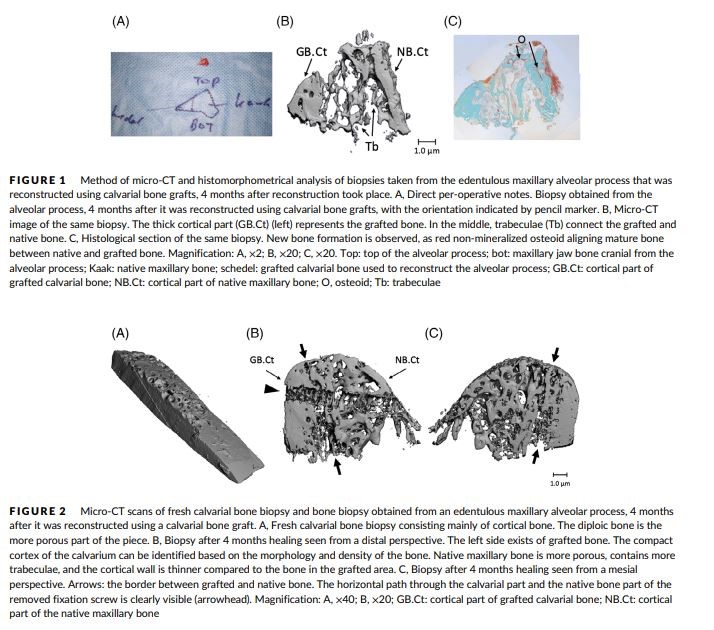 Histomorphometric and micro-CT analyses of calvarial bone grafts used to reconstruct the extremely atrophied maxilla